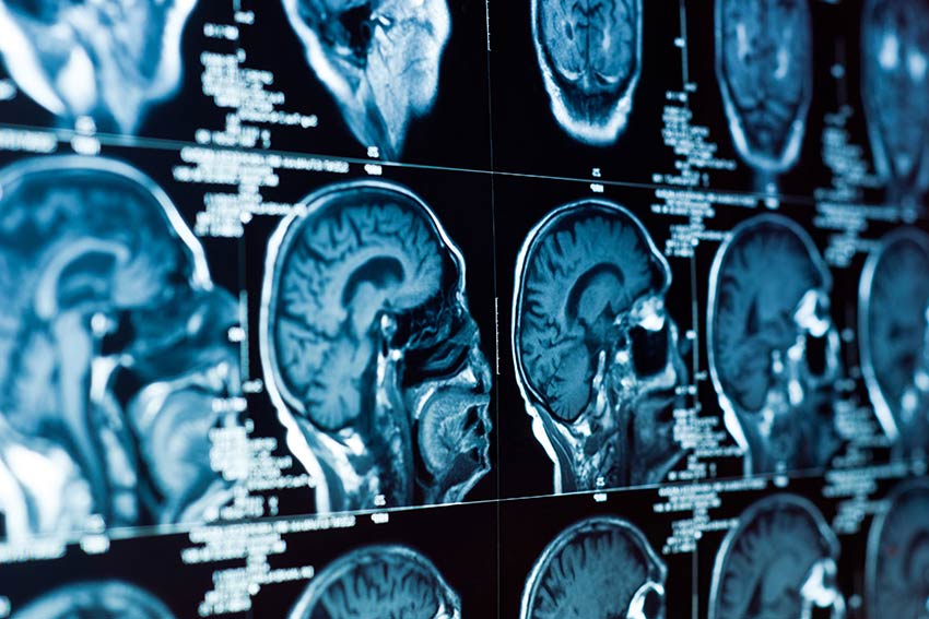 Closeup of a CT scan with brain and skull on it.