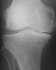 Knee deep in osteoarthritis research