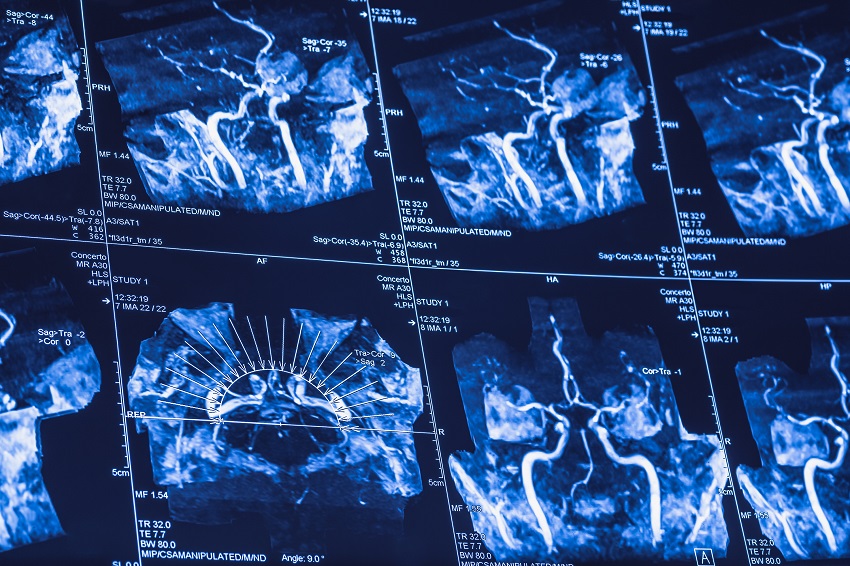 World-leading stroke research at AUT